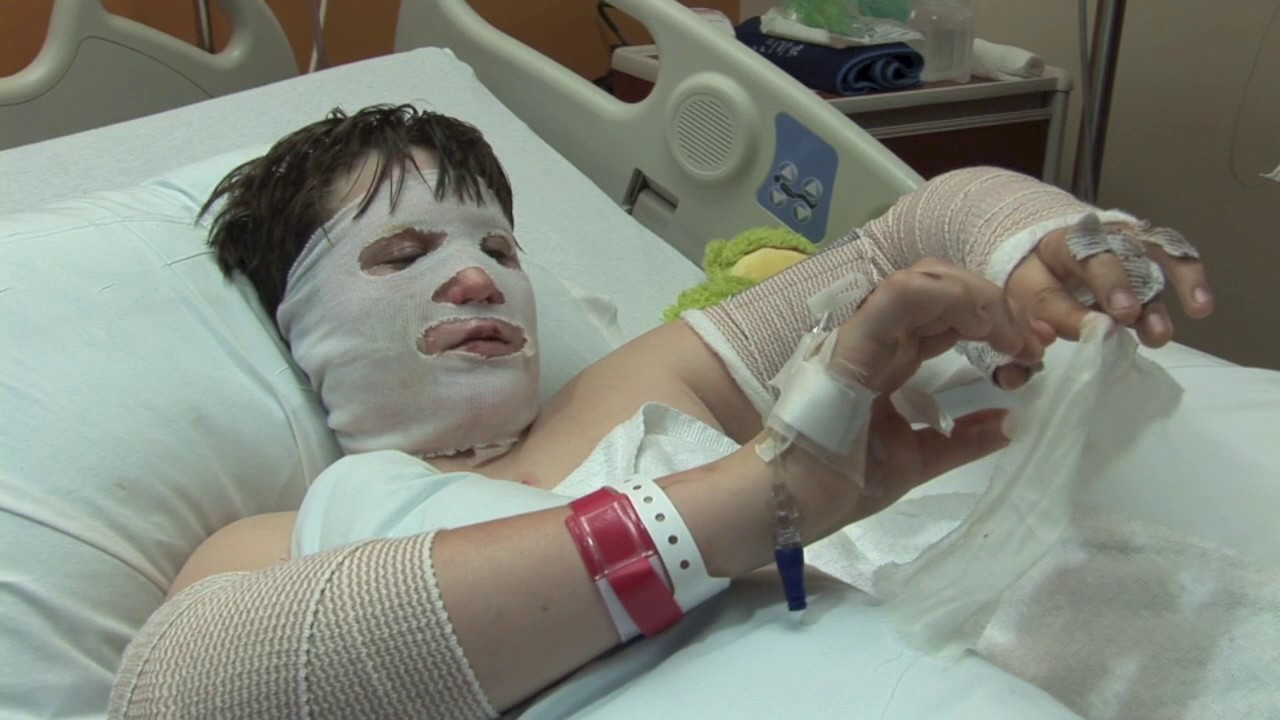Coping Club| Maverick copes with Burn Recovery | Norton Children’s Hospital