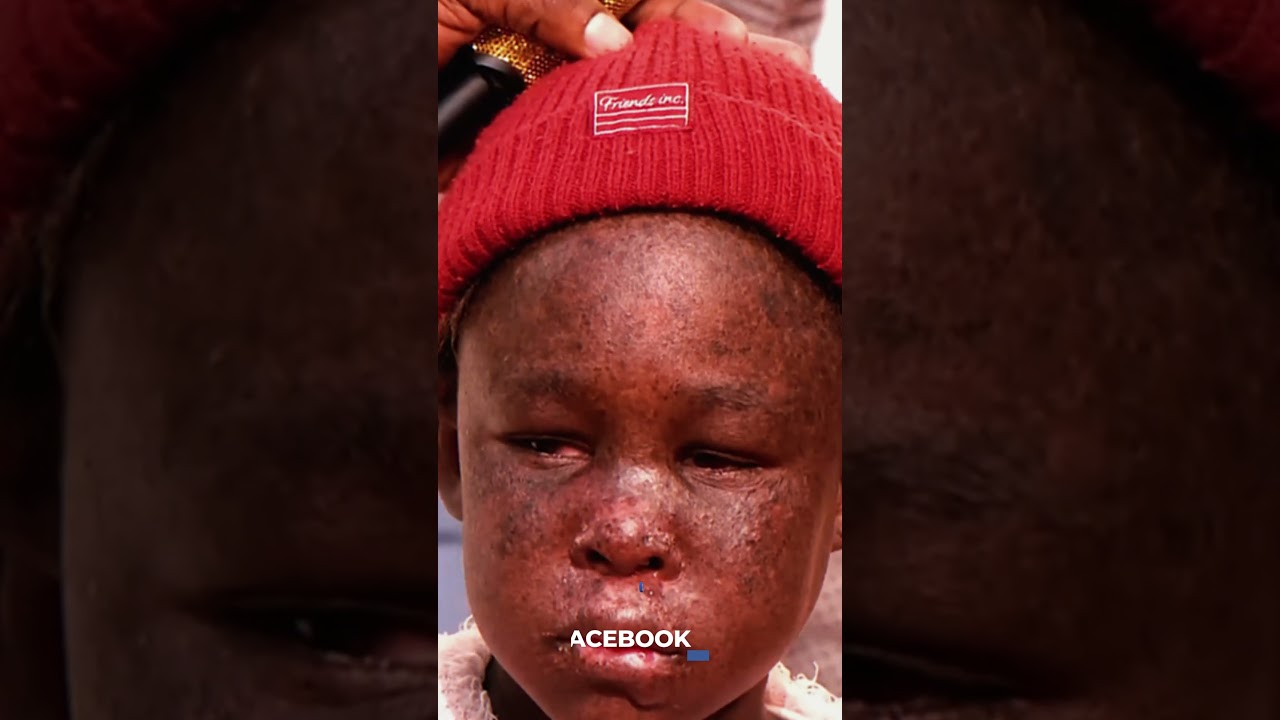 Miraculous Recovery: This Child is Completely Healed! 😲✨ #shorts #healing #jesus #alphlukau #god