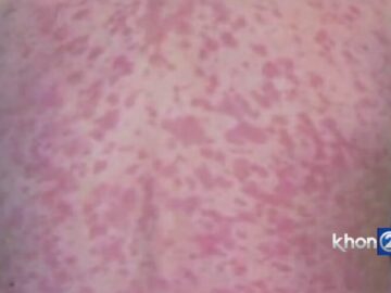 Oahu child infected with measles makes full recovery