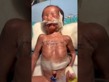 Very serious baby , please pray for recovery🙏🏽🙏🌎 #newborn #baby #love #viral