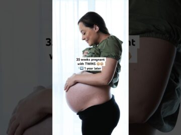 TWIN birth tummy recovery ❤️🩹 One year post C-section! #twins #twinmum #twinpregnancy #cesarean