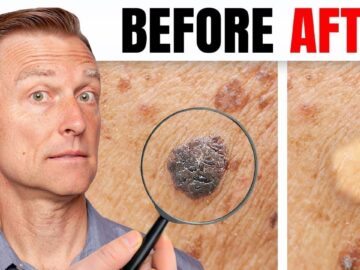 How to Remove Skin Tags and Warts Overnight – Dr. Berg Explains