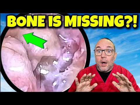 The “Optical Illusion” Ear: Partial Mastoidectomy with Hidden Dead Skin | Episode 672