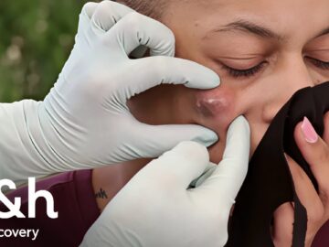 Punto negro en su rostro crece sin control | Dra. Sandra Lee: Especialista en piel | Discovery H&H